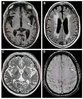 Total Cerebral Small Vessel Score Association With Hoehn and Yahr Stage in Parkinson’s Disease